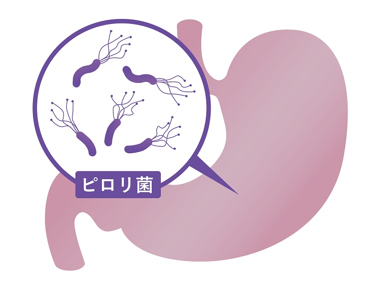 胃がん ピロリ菌